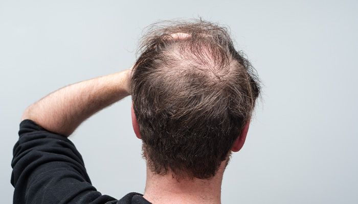 Haarausfall bei Männer
