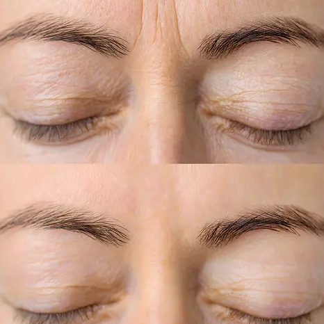 Augen mit Vorher Nachher vergleich